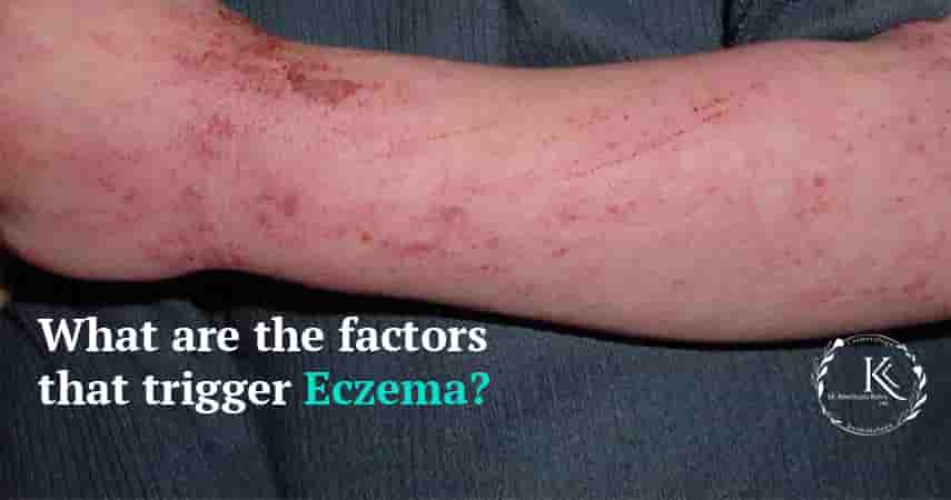 Eczema Treatment