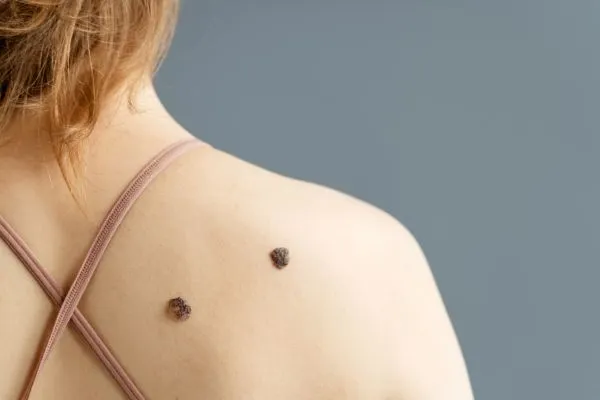 What Causes Warts and Are They Contagious?