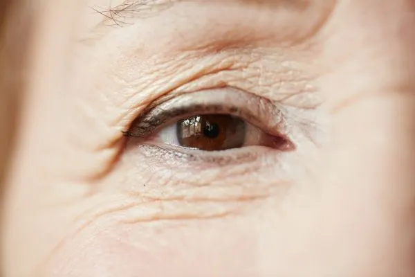 Can Laser Resurfacing Reduce Wrinkles and Fine Lines