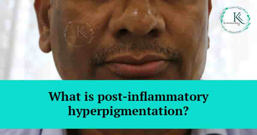 Post-inflammatory Hyperpigmentation