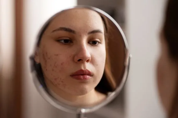 Medical Acne Facials vs Regular Facials: What’s Dermatologist-Recommended?
    