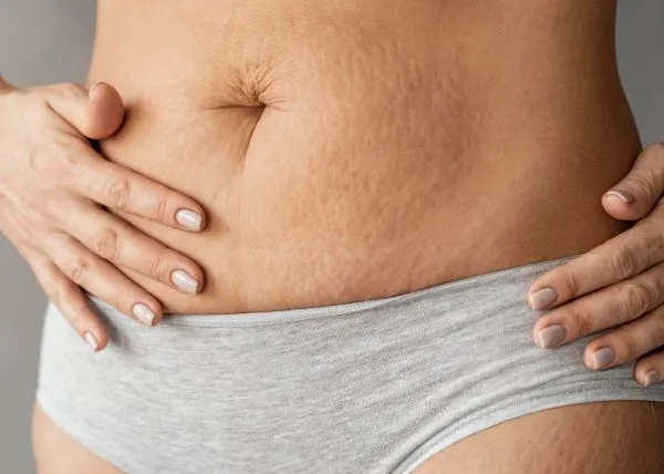 Best Treatments for Pregnancy Stretch Marks: What Really Works?