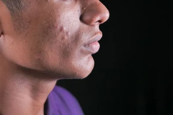 Cystic Acne vs Regular Pimples:What is the Difference?