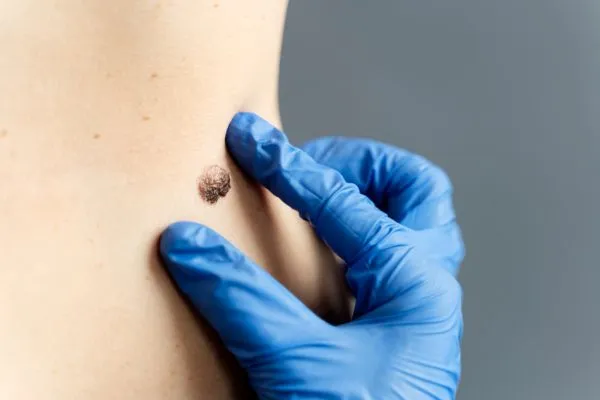 Are Skin Tags Dangerous? When Should You Remove Them? | Causes & Treatment