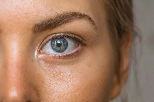 Dark Circles Under the Eyes: Causes, Types & Treatment Options