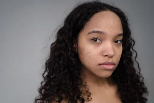 Face Pigmentation After Acne: Why Dark Spots Stay and How to Treat Them