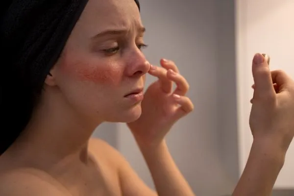 Why Your Face Stays Red | Causes, Symptoms & Treatment