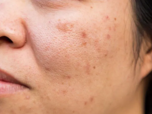 What Causes Large-Looking Pores and Can They Be Reduced?