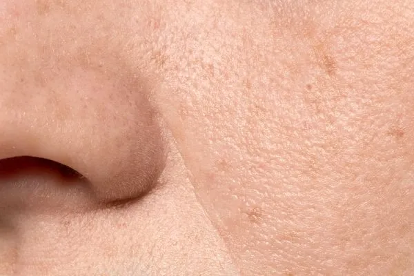 Can Microneedling Help Enlarged Pores and Uneven Skin Texture?
