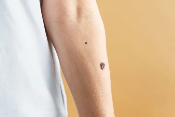 Does Mole Removal Leave a Scar?