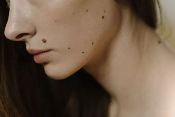 Why Some Moles Should Never Be Ignored: Warning Signs You Should Know