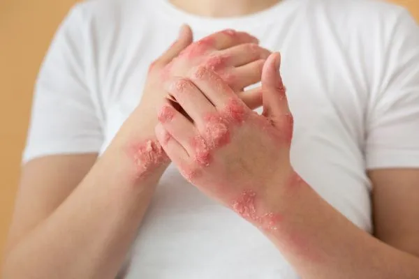 Can Psoriasis Affect Nails and Joints? Understanding Nail Psoriasis and Psoriatic Arthritis