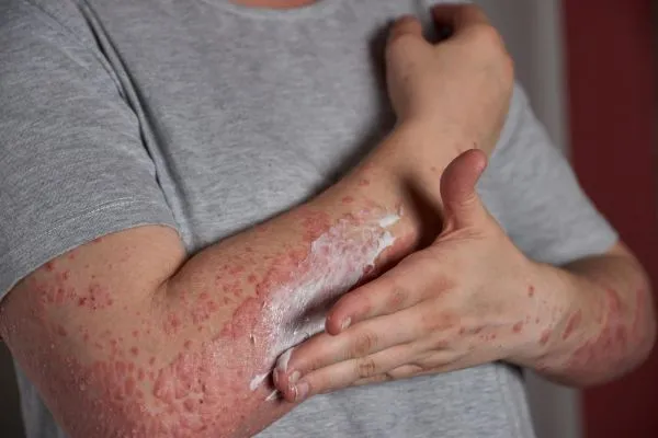 Psoriasis Is More Than Just Dry Skin: Causes, Symptoms & Treatment