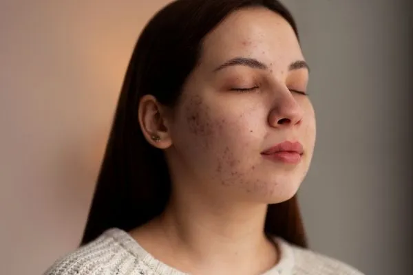Best Treatments for Pigmentation on Face