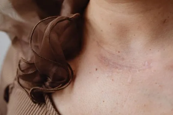 Understanding Keloids: Why Some Scars Keep Growing