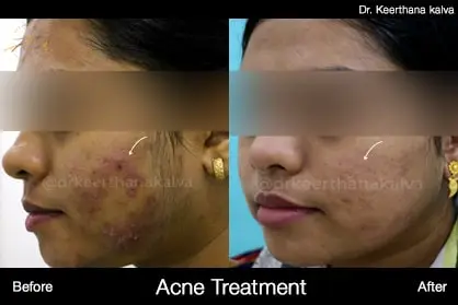 Acne Treatment before after Hyderabad