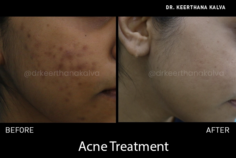 Acne Treatment before after Hyderabad