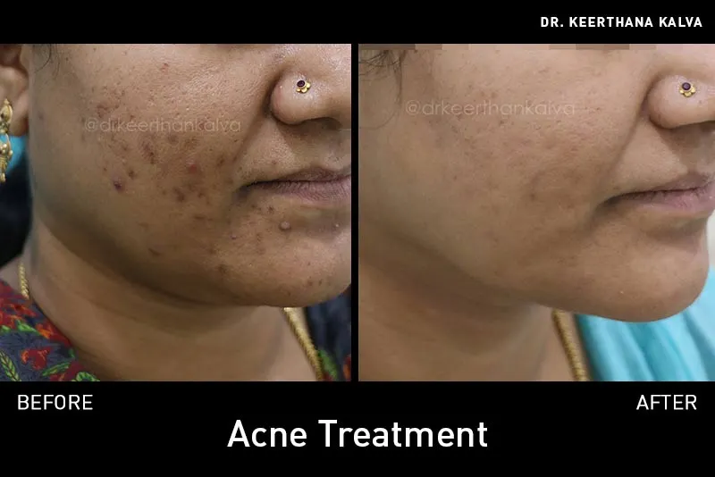 Acne Treatment before after Hyderabad