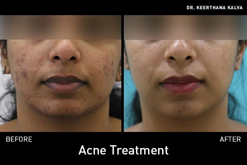 Pimple Treatment before after Hyderabad
