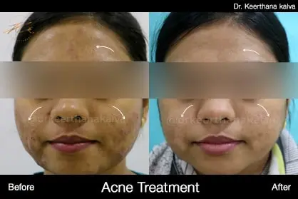 Pimple Treatment before after Hyderabad