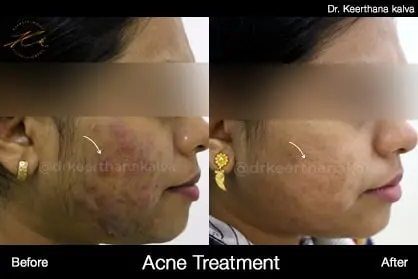 Pimple Treatment before after Hyderabad