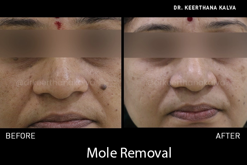 mole removal before after Hyderabad