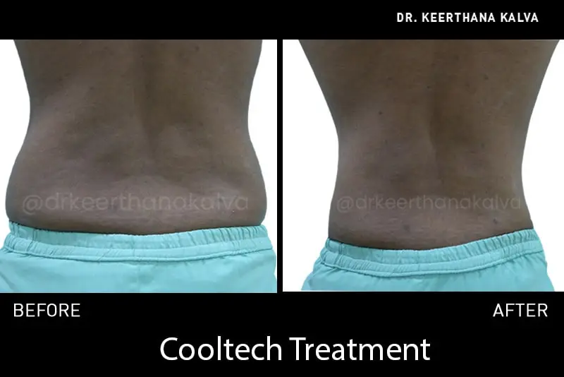 non surgical body contouring before after Hyderabad