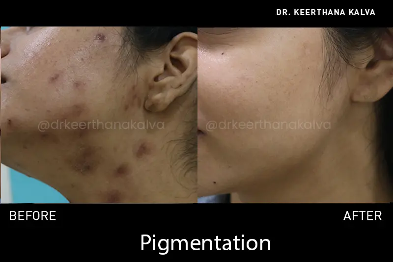 hyperpigmentation treatment before after Hyderabad