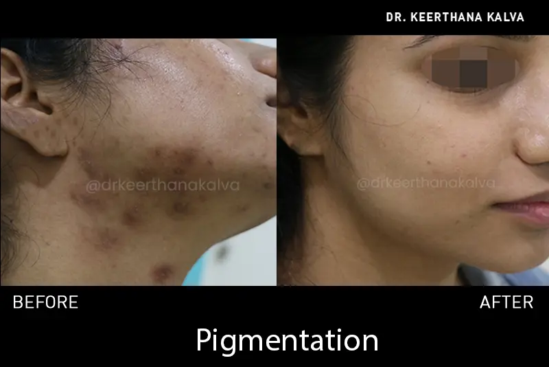 hyperpigmentation treatment before after Hyderabad