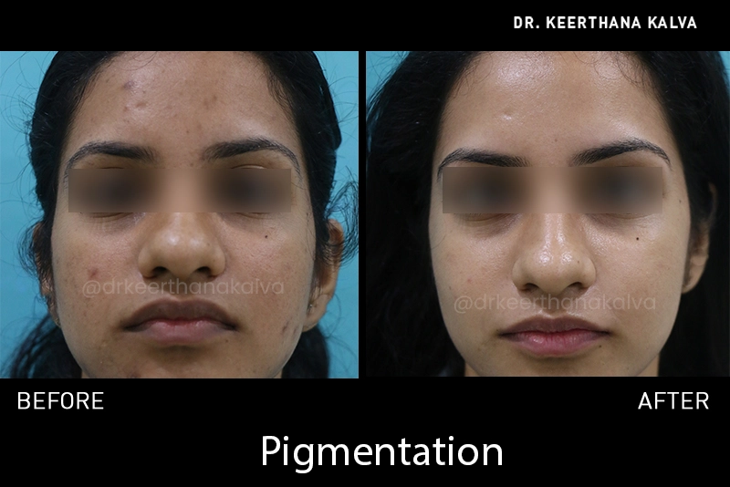 hyperpigmentation treatment before after Hyderabad