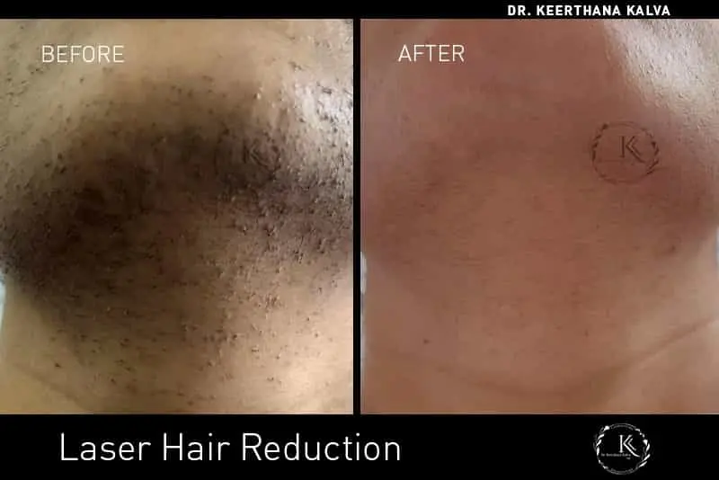 laser hair removal before after Hyderabad