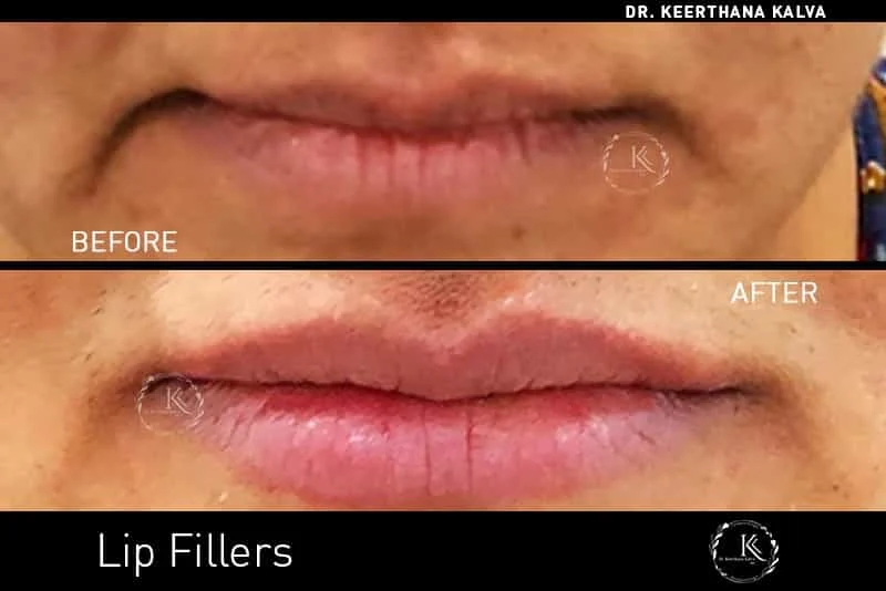 dermal fillers before after Hyderabad