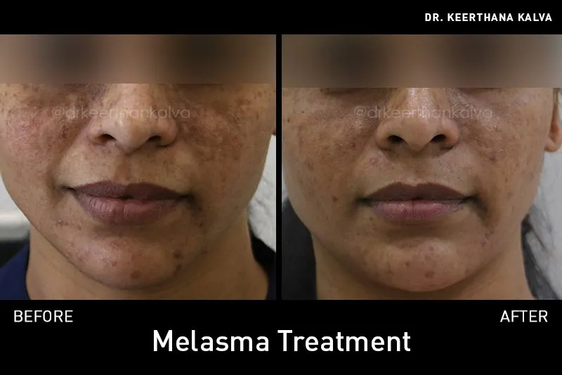 melasma treatment before after Hyderabad