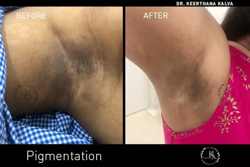 Pigmentation Treatment before after Hyderabad