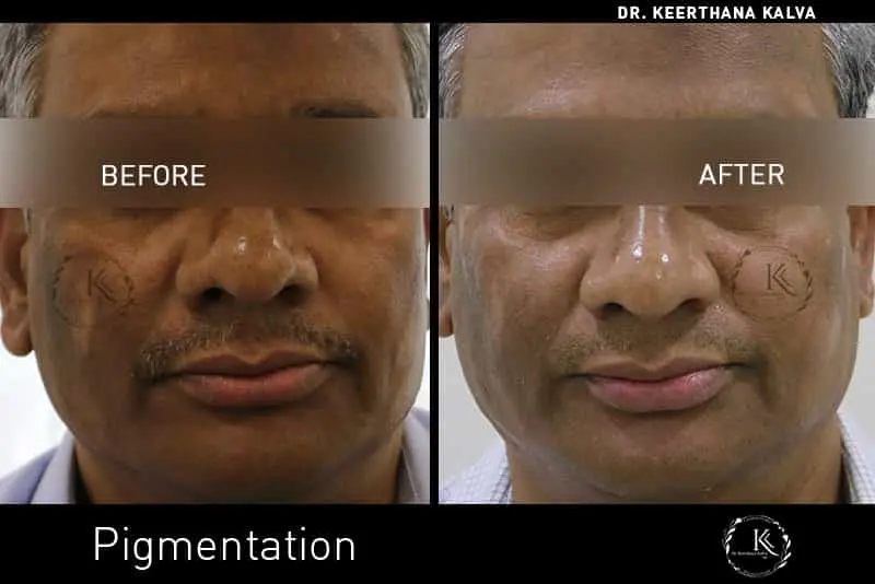 Pigmentation Treatment before after Hyderabad