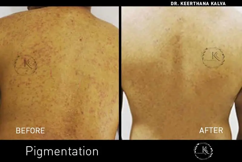 Pigmentation Treatment before after Hyderabad