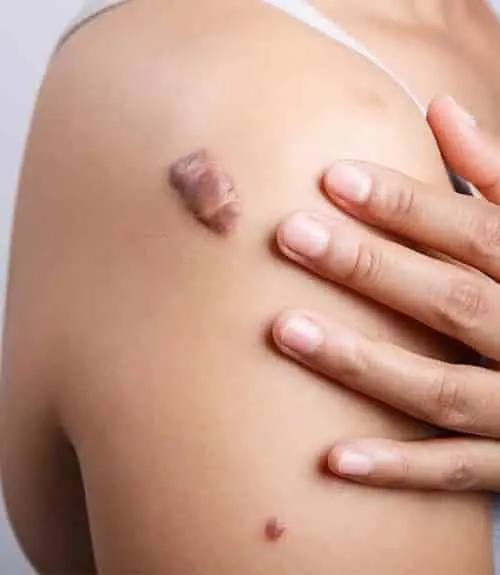 Keloids