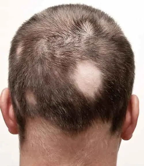 Alopecia treatment in hyderabad