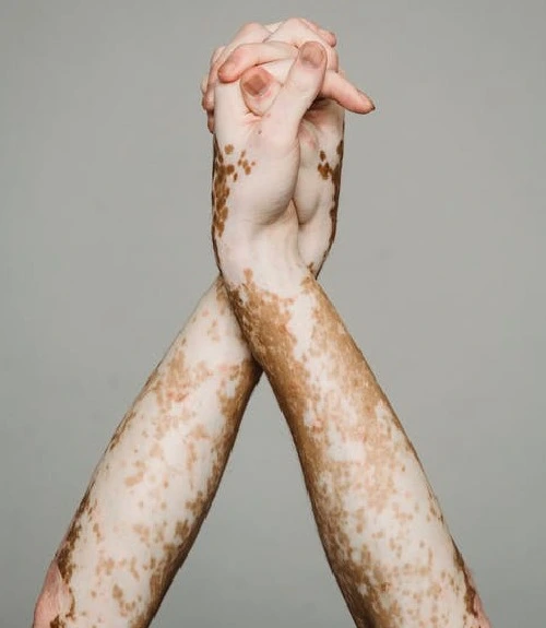 treatment for vitiligo in Hyderabad