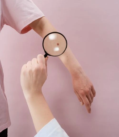 Mole Removal in Hyderabad