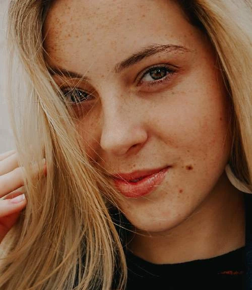 Hyperpigmentation Treatment Hyderabad