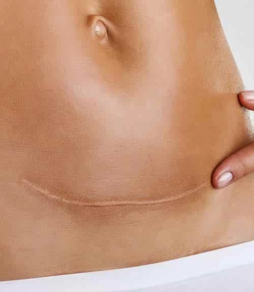 C Section Scar Revision in Hyderabad