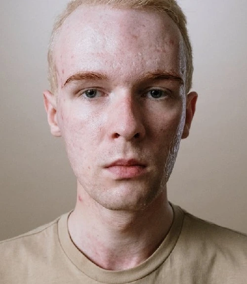 Acne Scar Reduction in Hyderabad