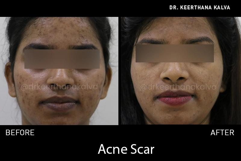 acne scar treatment in Hyderabad