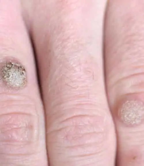 Warts Removal Treatment in Hyderabad