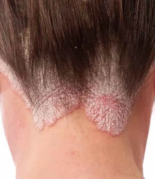 Psoriasis Treatment in Hyderabad