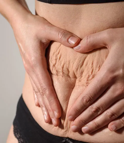 Stretch Marks Reduction in Hyderabad