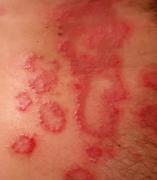 Eczema Treatment in Hyderabad