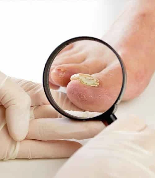 treatment for skin fungal infection
in Hyderabad