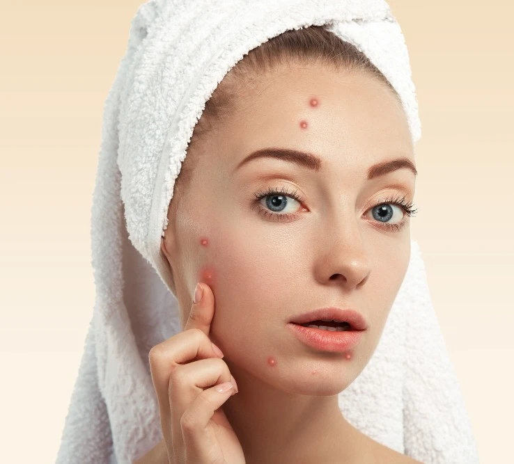 Acne Scar Reduction